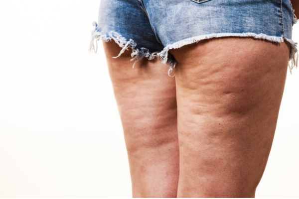 Cellulite

La cellulite provient d'une altération des tissus graisseux, créant un aspect inesthétique.

    En savoir plus