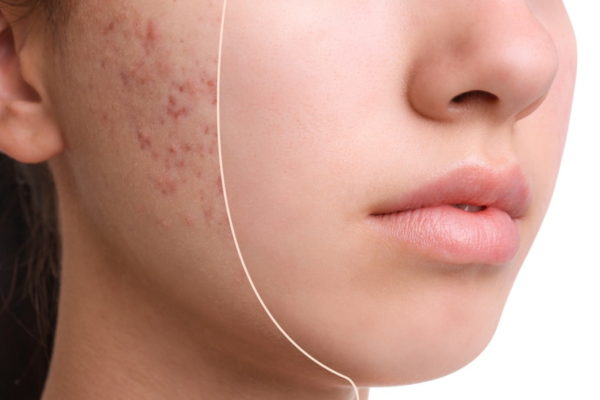 Acne

The AC Dual Laser treatment targets acne-causing bacteria and reduces skin inflammation.

    Learn More
