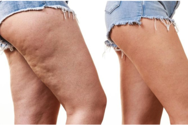 Saddle Bags

Saddle bags refer to the accumulation of fat and cellulite around the hips, buttocks, and outer thighs.

    Learn More