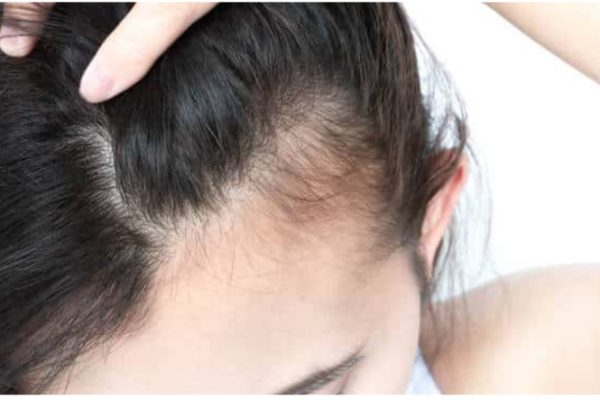 Hair Loss

Mesotherapy and microneedling stimulate regrowth, slow hair loss, and naturally increase hair density.

    Learn More
