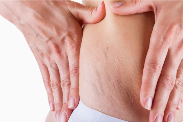 Stretch Marks

Microneedling and nano-fractional treatments help reduce stretch marks, firm the skin, and repair skin damage.

    Learn More